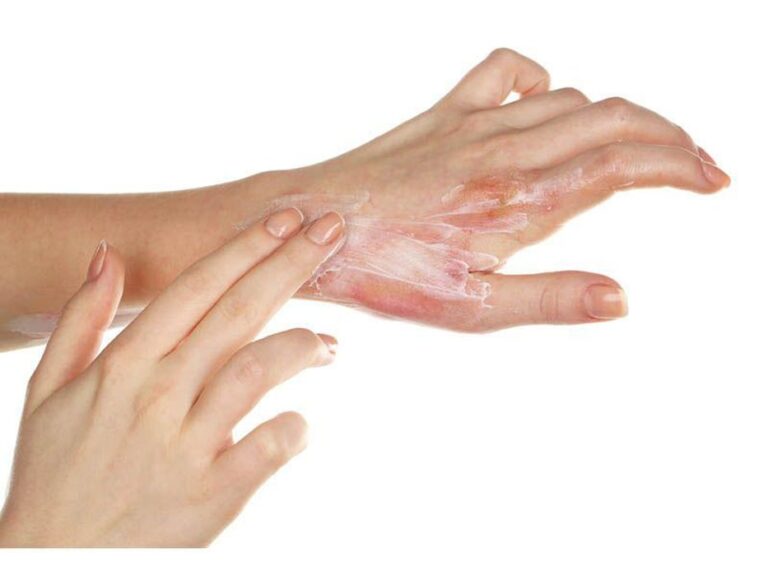 Understanding the Risks and Treatment of BeastEater Face Chemical Burns Causes, Symptoms, and Prevention